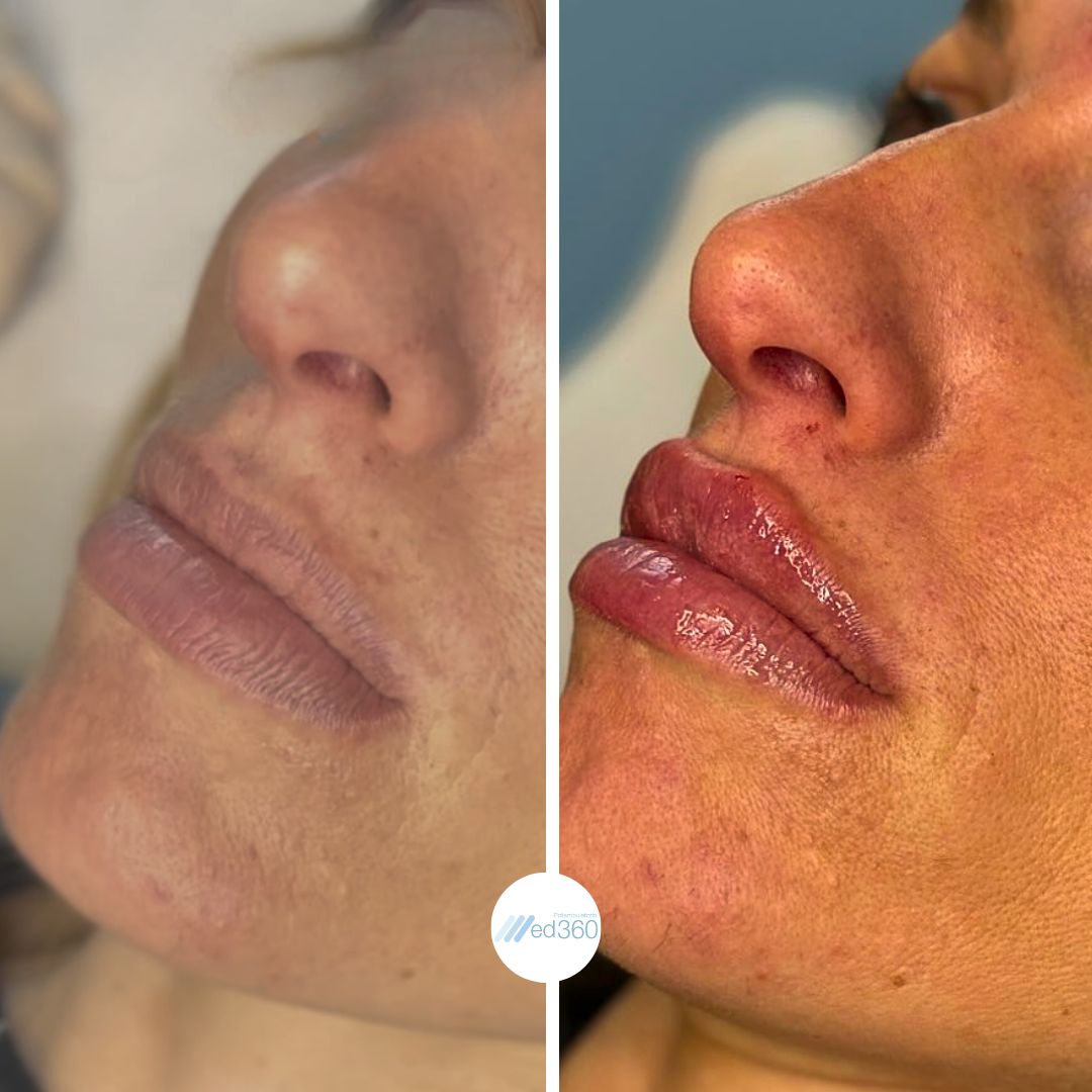 Filler Labbra