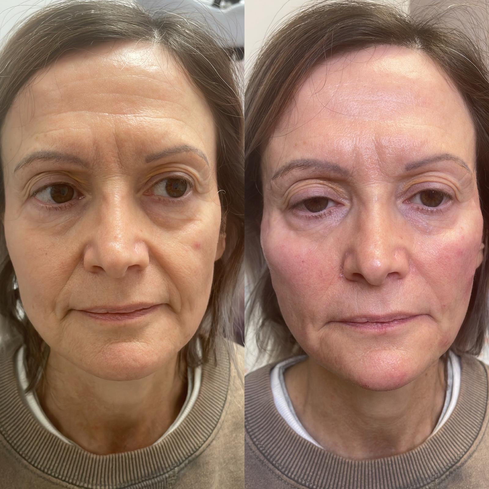PRP e Biostimolazione