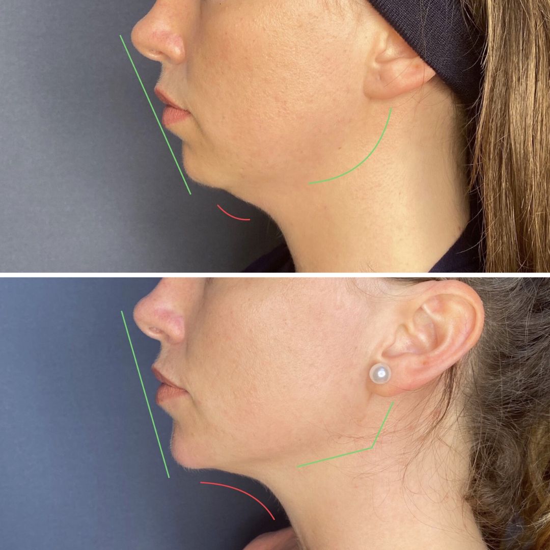 Mentofiller e Filler Zigomi